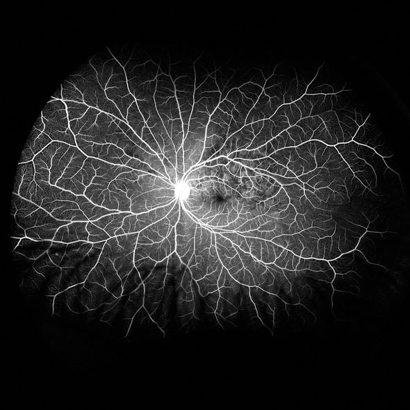 Image of the retina using fluorescein angiography