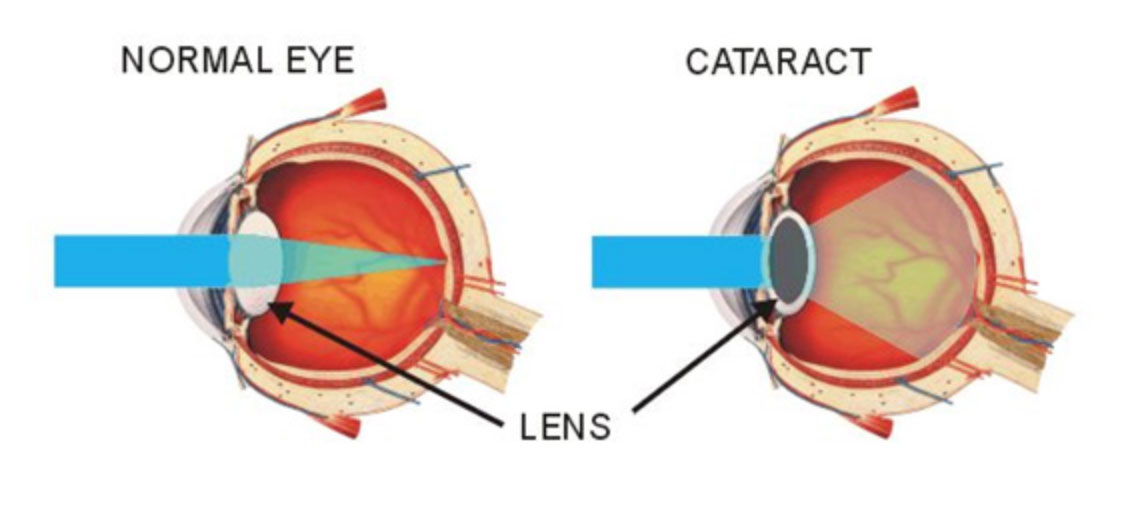 Diagram showing normal eye vs an eye with cataract