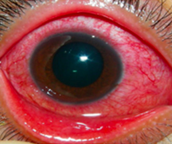 Redness and swelling seen in conjunctivitis