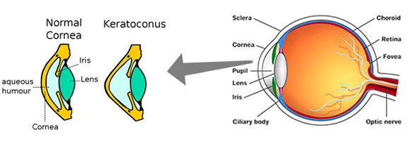 Diagram showing a normal cornea vs a cornea with keratoconus