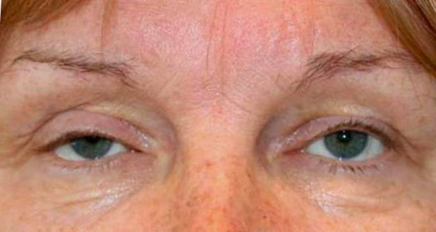Drooping upper eyelid (ptosis)