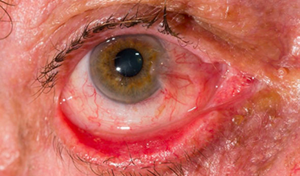 Turning out of the lower eyelid (ectropion)