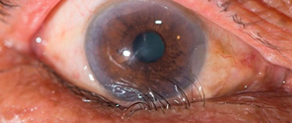 Turning in of the lower eyelid (entropion)