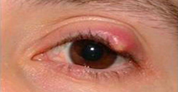 Drooping upper eyelid (ptosis)